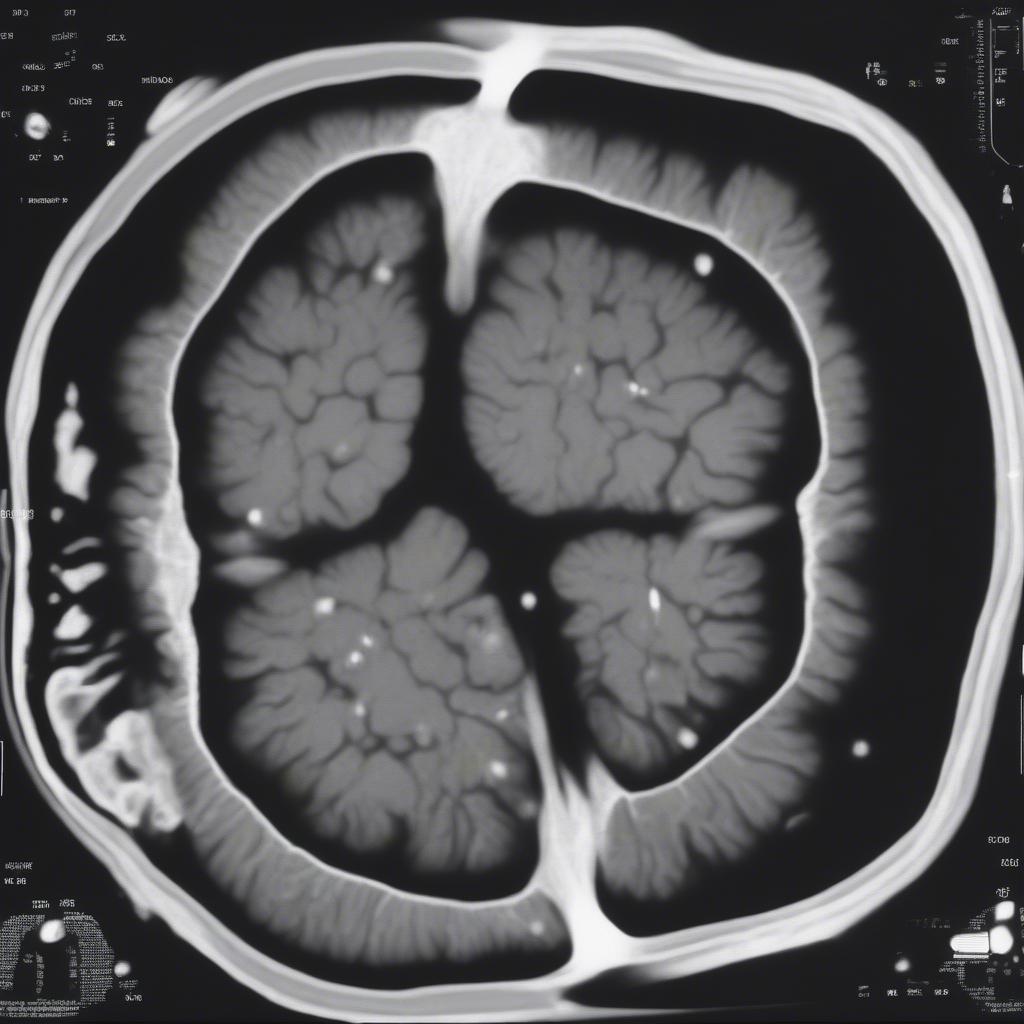 Ring Sign trên phim MRI